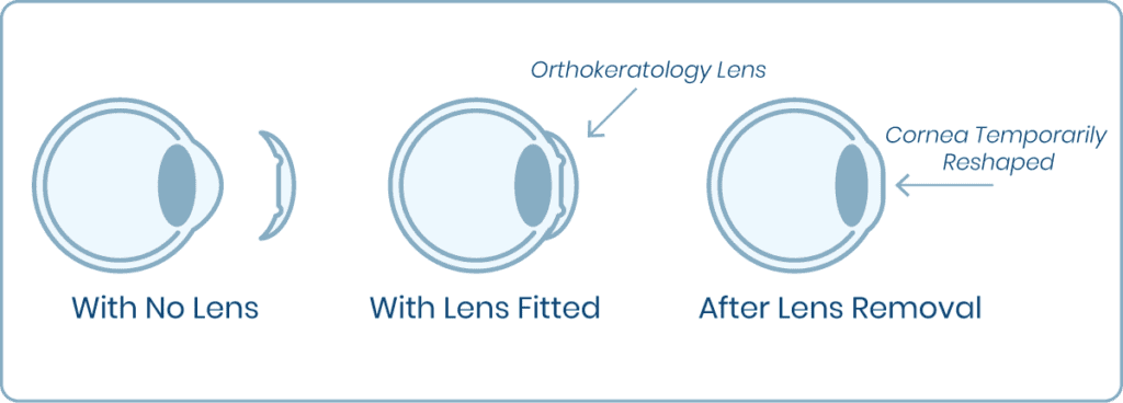 Ortho-K In Seattle | Orthokeratology Center Of Washington