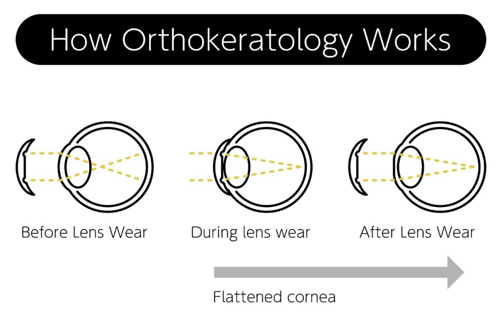 how orthokeratology works