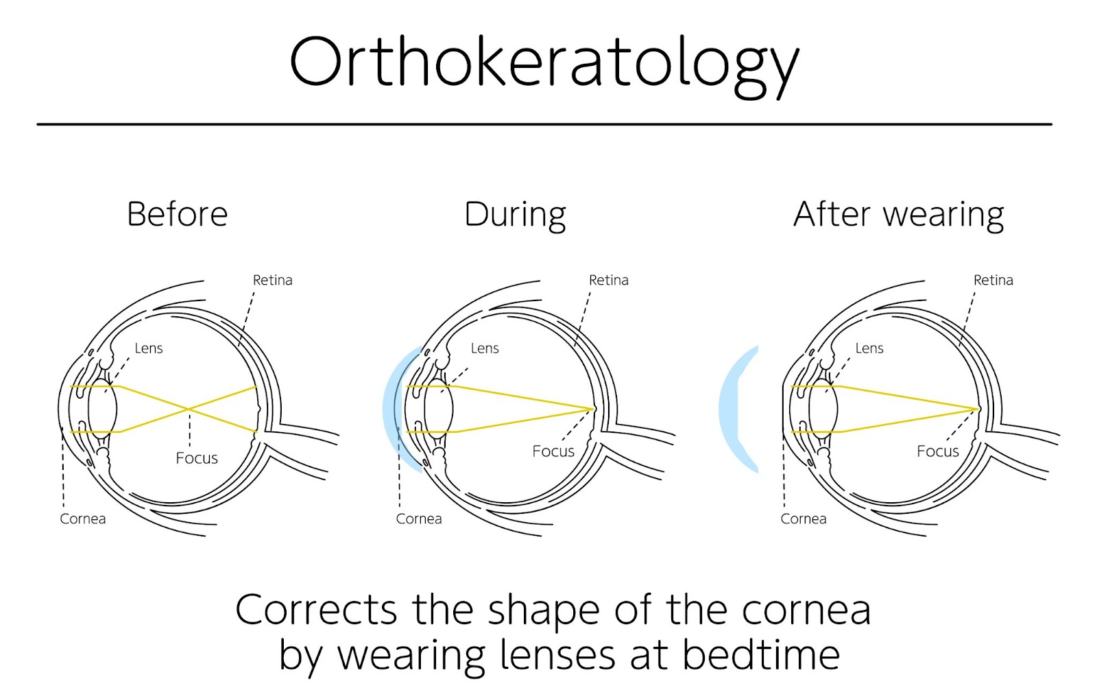 CRT contact lenses