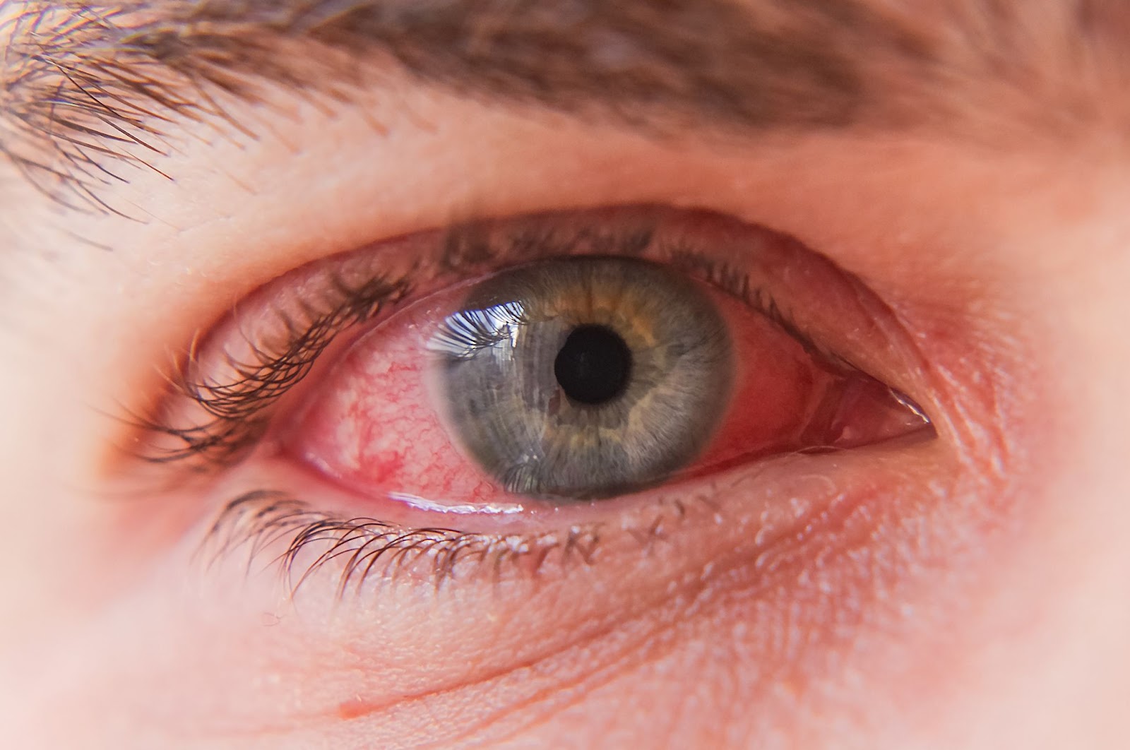 red eye irritation